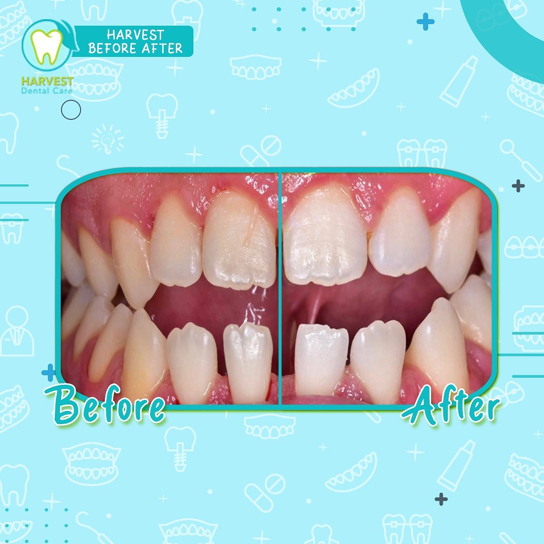 TOOTH WHITENING (BLEACHING)